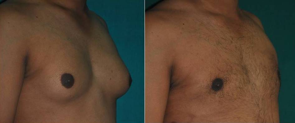 Male chest liposuction in Ernakulam